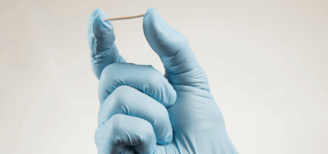 Implanon em Campinas: contracepção segura e coberta pelos planos de saúde